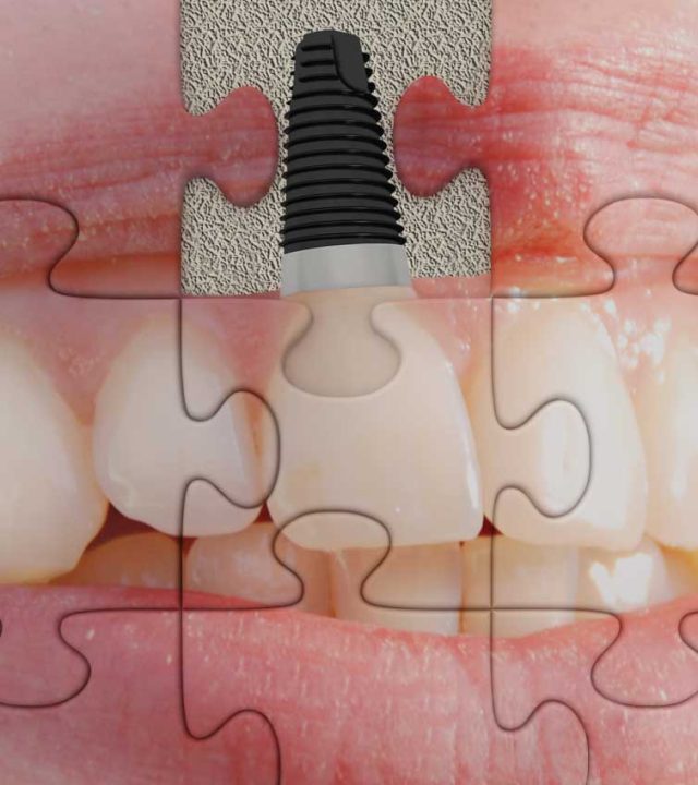Implantes2